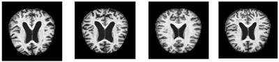 Prediction of Alzheimer's disease stages based on ResNet-Self-attention architecture with Bayesian optimization and best features selection